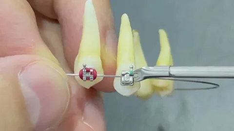 Picking Ceramic Fixes Instead of Old-School Braces